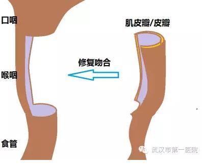 下咽癌转瓣2.jpg